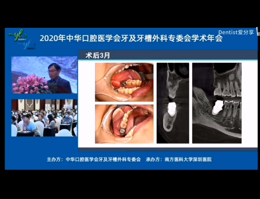 2020牙槽外科年會—牙種植術(shù)的討論